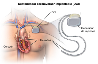 Corte transversal del corazón que muestra las vías de conducción eléctrica y el ritmo normal del corazón