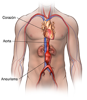 Vista frontal del contorno de un hombre donde se observa un aneurisma de la aorta abdominal.