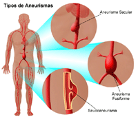 Ilustración de tipos de aneurismas