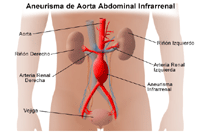 Ilustración de aneurisma de aorta abdominal infrarrenal