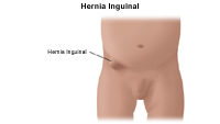 Ilustración de una hernia inguinal