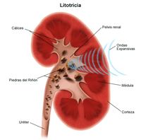 Ilustración de litotricia