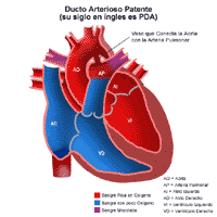Anatomía de un corazón con conducto arterial persistente