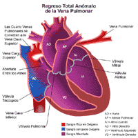 Anatomía de un corazón con drenaje venoso pulmonar anómalo total