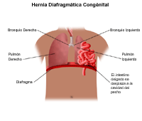 Ilustración de una hernia diafragmática congénita