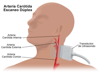 Ilustración de una ecografía dúplex de la arteria carótida