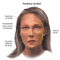 Ilustración de la parálisis de Bell