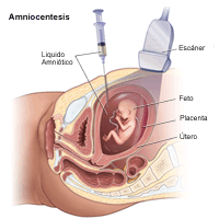 Ilustración que muestra una amniocentesis