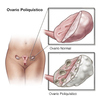 Ilustración de un ovario polycystic