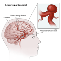 Ilustración de un aneurisma cerebral