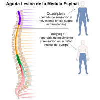 Ilustración de lesiones agudas de la médula espinal que generarían tetraplejia o paraplejia.
