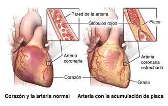 Corazón y arteria normal, arteria con acumulación de placa