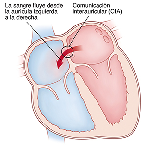 Corte transversal de vista frontal de un corazón que muestra la comunicación interauricular. Las flechas indican que la sangre está fluyendo a través de la comunicación interauricular desde la aurícula izquierda hacia la aurícula derecha.