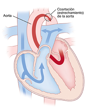 Vista de las cuatro cavidades del corazón que muestra la coartación de la aorta. Las flechas indican el flujo sanguíneo limitado en la aorta.