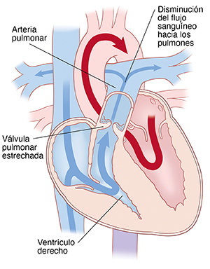 Vista de las cuatro cavidades del corazón, donde se observa estenosis pulmonar. Las flechas indican que fluye menos sangre a través de la válvula pulmonar.