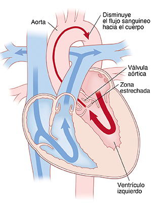 Vista de las cuatro cavidades del corazón, donde se observa estenosis subaórtica. Las flechas indican que fluye menos sangre a través de la aorta.
